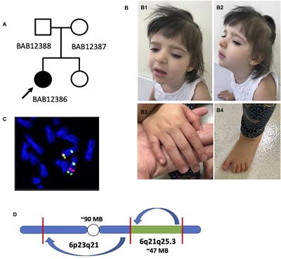 Chromoanagenesis Event Underlies a de novo Pericentric and Multiple Paracentric Inversions in a Single Chromosome Causing Coffin–Siris Syndrome